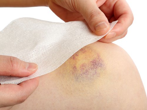 Xuất hiện vết bầm tím trên da, rất có thể bạn đang mắc bệnh này, đây là dấu hiệu cần được khám sớm