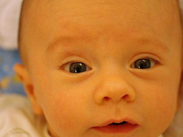 Trẻ sơ sinh bị vàng da vàng mắt như thế nào là nguy hiểm?