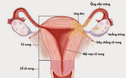 Tìm hiểu tắc vòi trứng ở phụ nữ