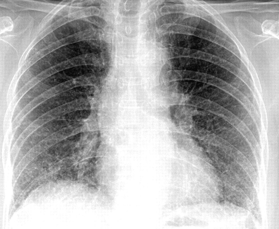 Tìm hiểu về bệnh phổi kẽ