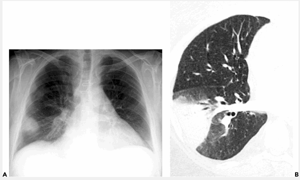 Dấu hiệu nhận biết bệnh viêm phổi thùy