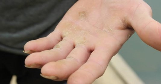 Cách loại bỏ chai chân tay