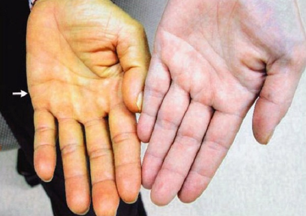 Nguyên nhân và triệu chứng của bệnh vàng da