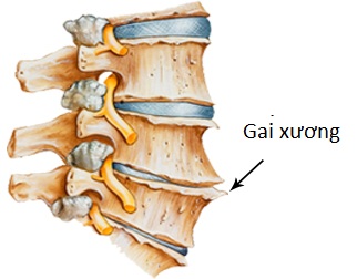 Tìm hiểu về chứng đau lưng do gai cột sống