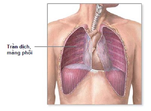 Tràn dịch màng phổi,  nguy hiểm khó lường