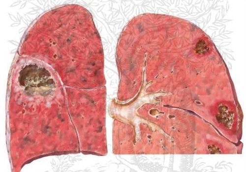 Xơ phổi – Căn bệnh nguy hiểm nên lưu ý
