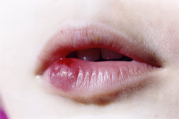 Nguyên nhân, triệu chứng của ung thư môi