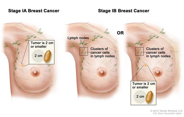 Ung thư vú: nguyên nhân và cách phòng ngừa ( Phần 2)