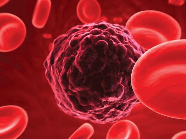 5 dấu hiệu bệnh ung thư tế bào máu