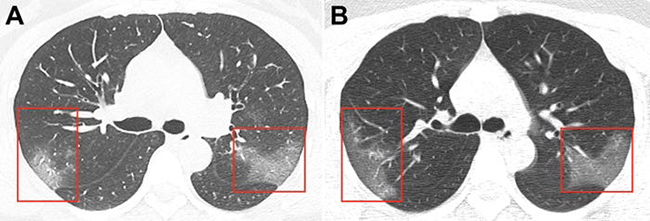 Hình ảnh phổi của bệnh nhân nhiễm Covid-19 bị virus Corona tàn phá