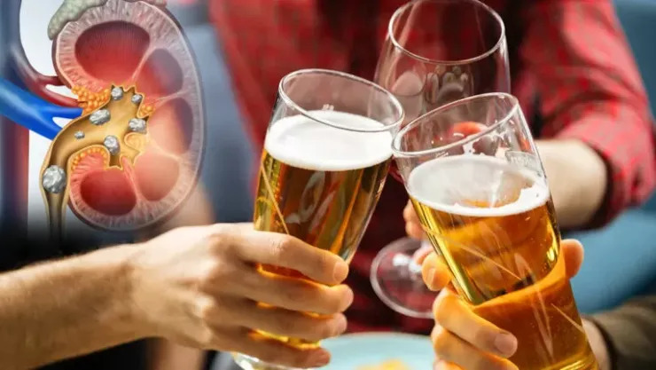 Người bị sỏi thận nên và không nên uống gì?